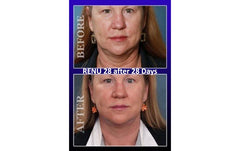 4 Tubes of RENU 28 - (80 ml / 2.7 FL OZ Skin Revitalizing Gel)